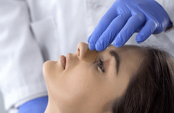 Revision Rhinoplasty in Sydney